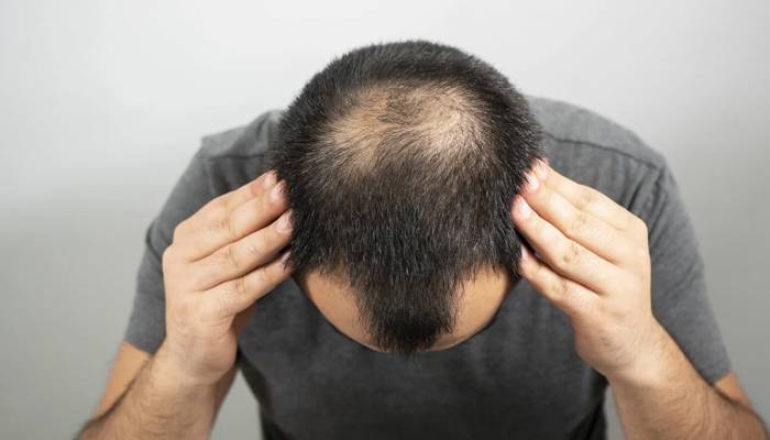 سائنسدانوں نے گنج پن کا حادثاتی علاج دریافت کرلیا