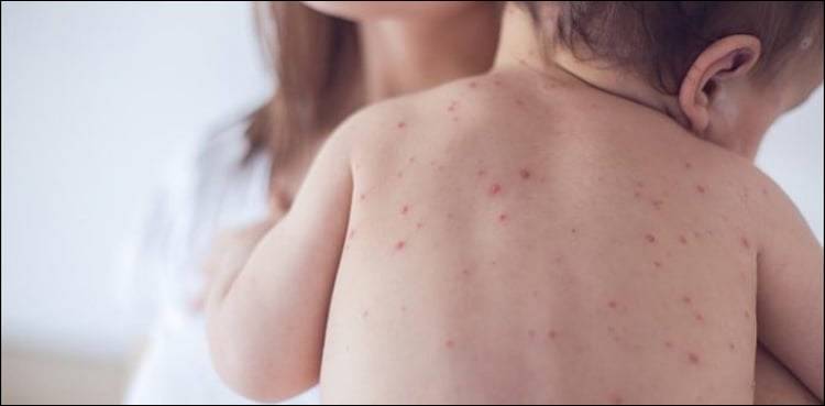 ملک میں خسرہ اور روبیلا سے بچاؤ کی ویکسینیشن مہم کا آغاز 
