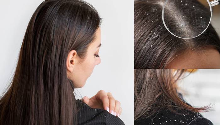 بالوں کا گرنا بند،خشکی اور کھجلی سے نجات کا آسان دیسی نسخہ 