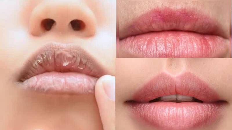 سردیوں میں ہونٹ کیوں پھٹتے ہیں؟ ماہرین نے بڑی وجہ بتا دی