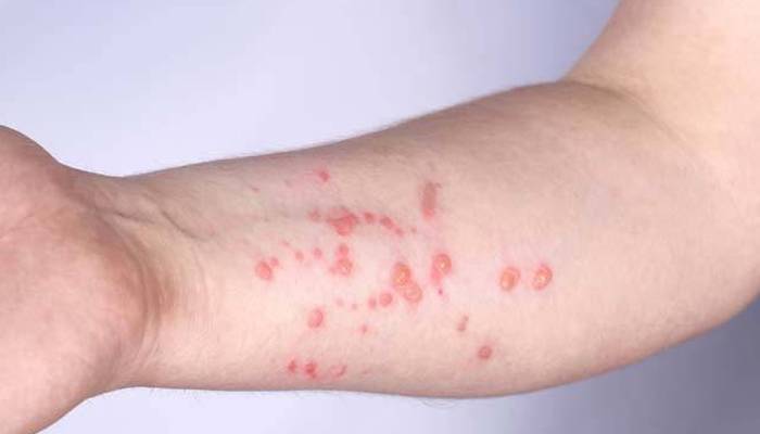 منکی پاکس کا خطرہ سنگین ہوگیا 