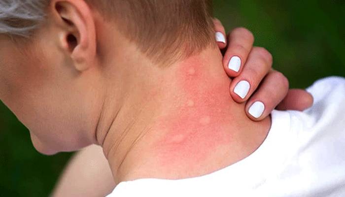 مچھرکچھ انسانوں کو زیادہ کیوں کاٹتے ہیں؟ دلچسپ تحقیق منظرعام پر آگئی